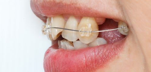 Crooked or overlapping teeth